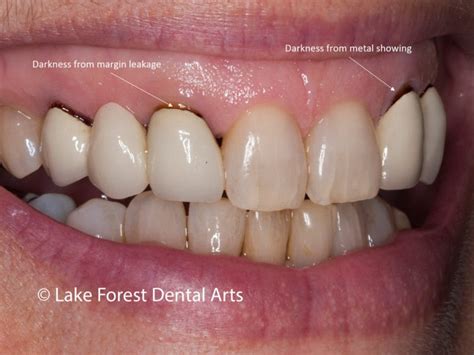 metal housing around gums|metal under crown teeth.